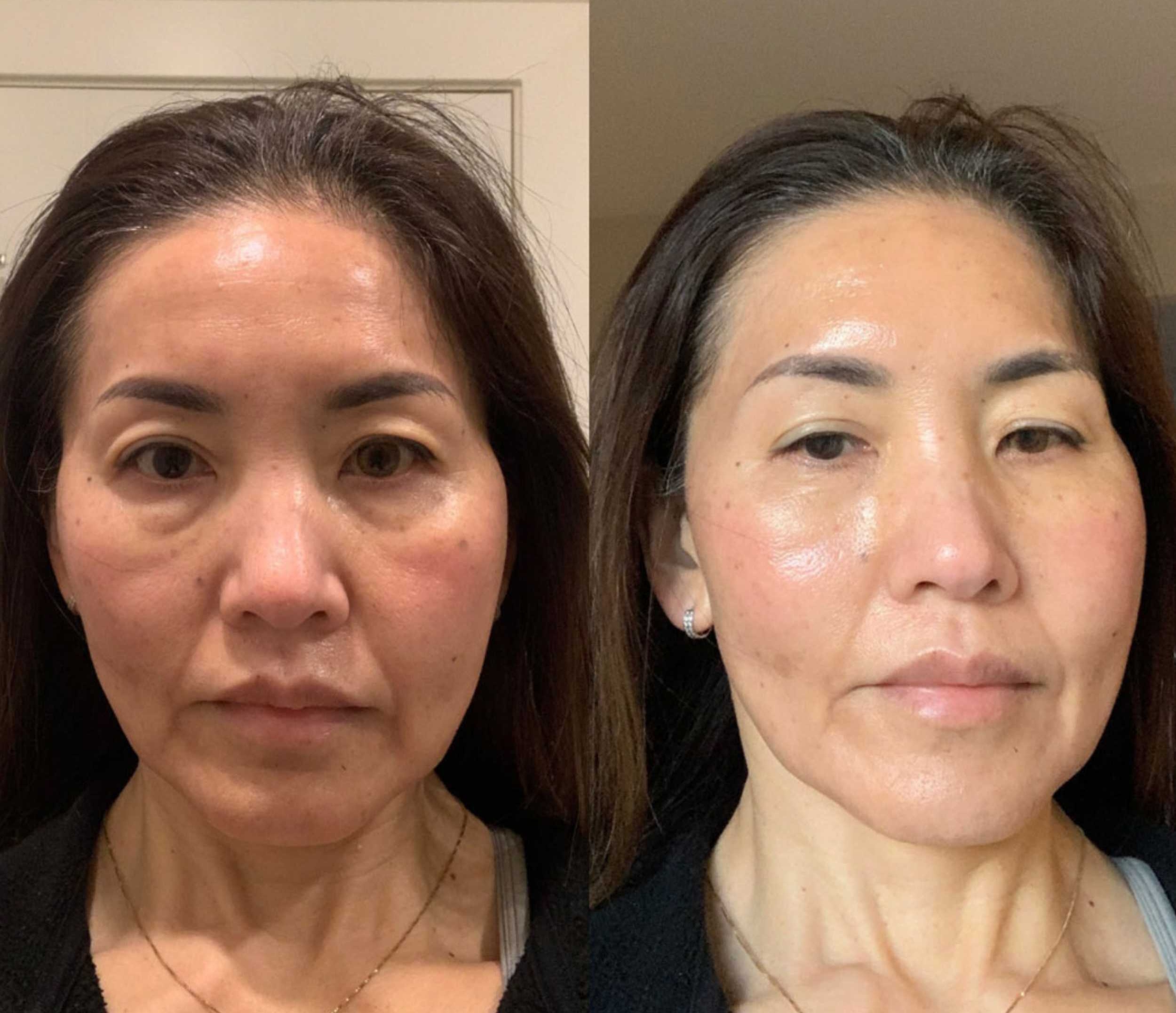 Before and after: Full Face Rejuvenation