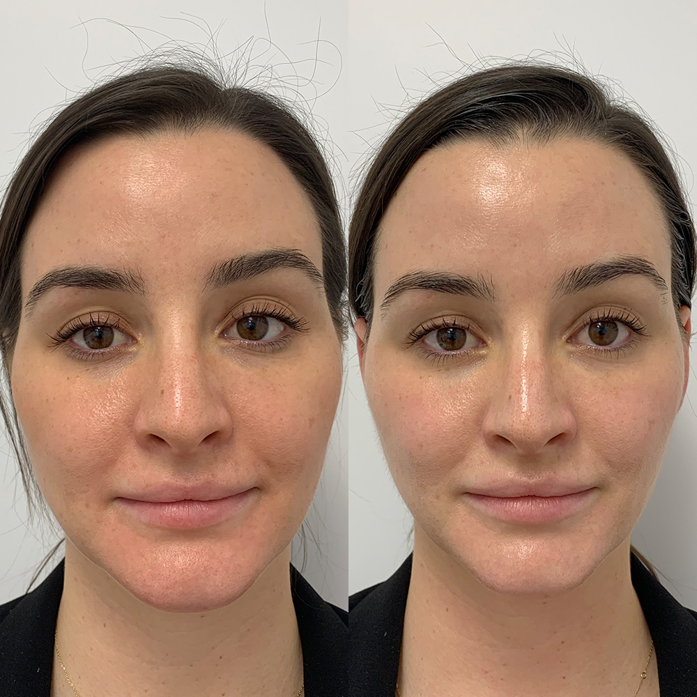 Before and after: Skin Smoothing & Radiance